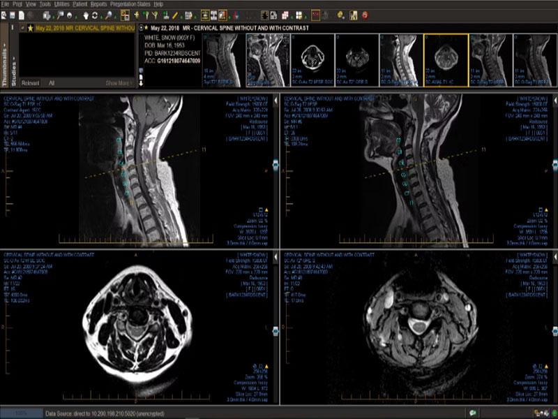 ProtonPACS Software - Cervical Spine Mr Showing Spine Labeling
