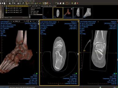ProtonPACS Software - Ankle CT Demonstrating Viewer Capability