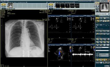 VEPRO Lungs
